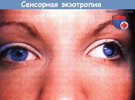 Сенсорная экзотропия