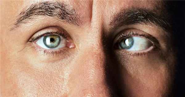 Расходящееся косоглазие