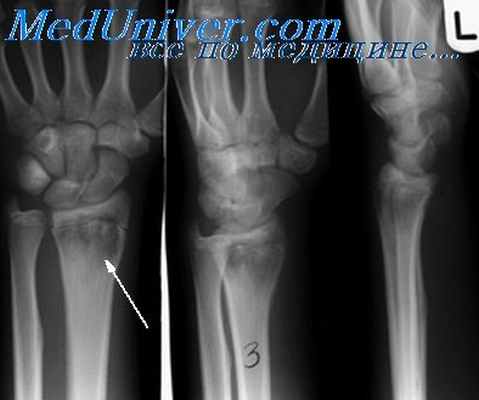 остеомиелит