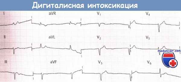 Дигиталисная интоксикация