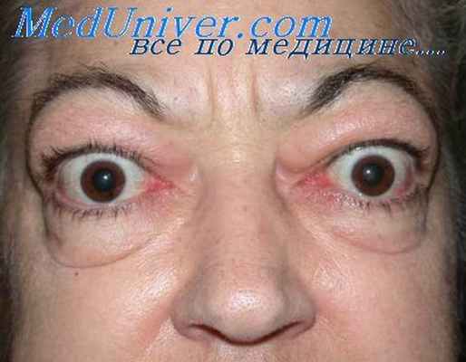 тиреотоксикоз