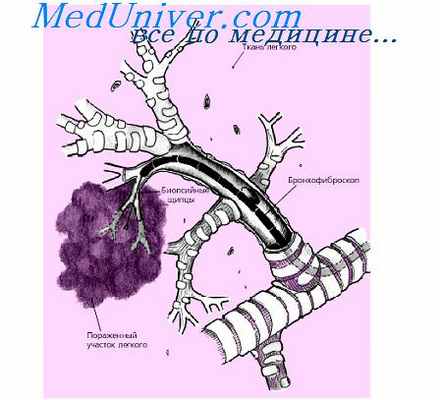 эйкозаноиды и воспаление бронхов