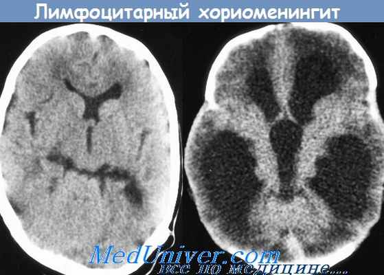 серозный менингит