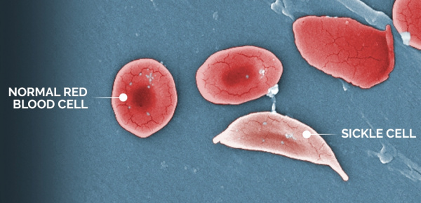 Серповидно-клеточная анемия
