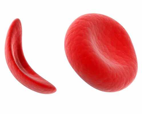 Атлеты с серповидно-клеточными особенностями подвержены большему риску неблагоприятных клинических исходов