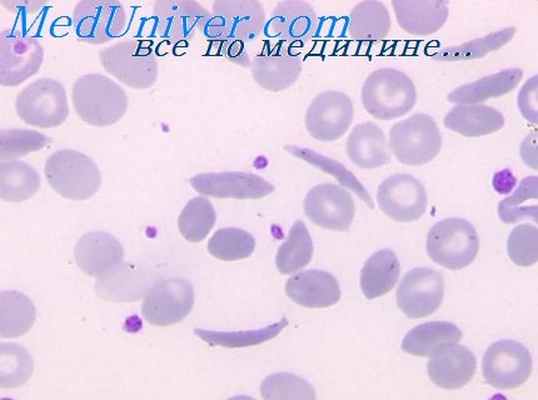 серповидно-клеточная анемия