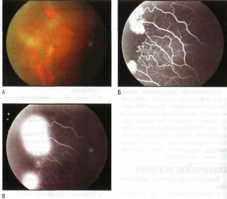 Пролиферативная III стадия серповидно-клеточной ретинопатии