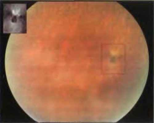 Серповидно-клеточная ретинопатия, очаги «чёрной лучистости»