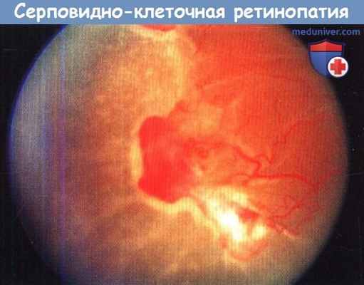 Серповидно-клеточная ретинопатия