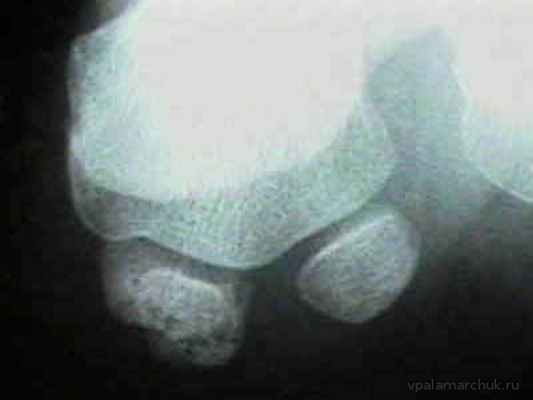 Сесамоидит