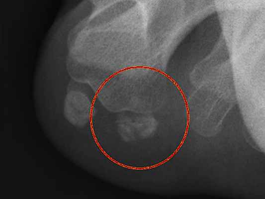 перелом сесамовидной