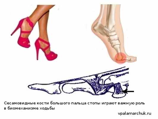 болит при ходьбе на каблуках