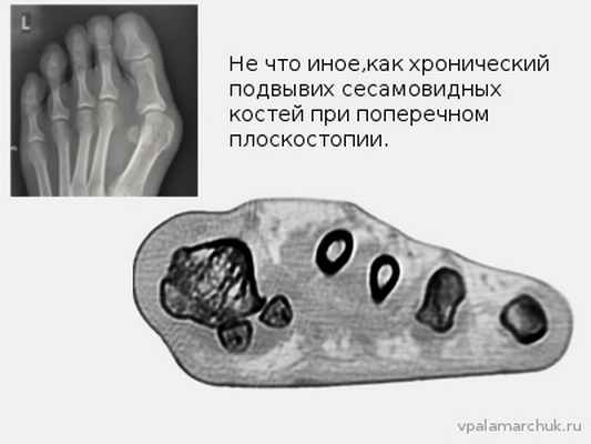вывих сесамовидных при поперечном плоскостопии