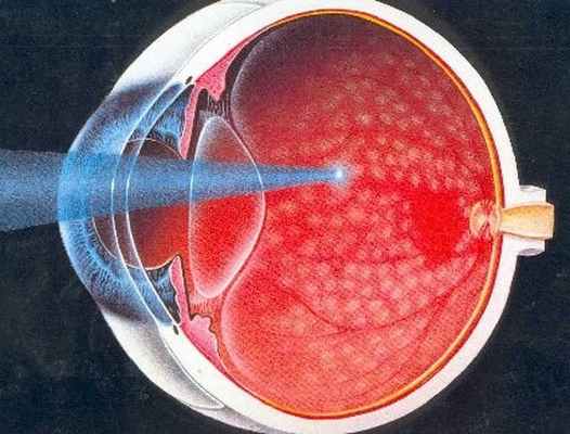 Схема лазеркоагуляции сетчатки