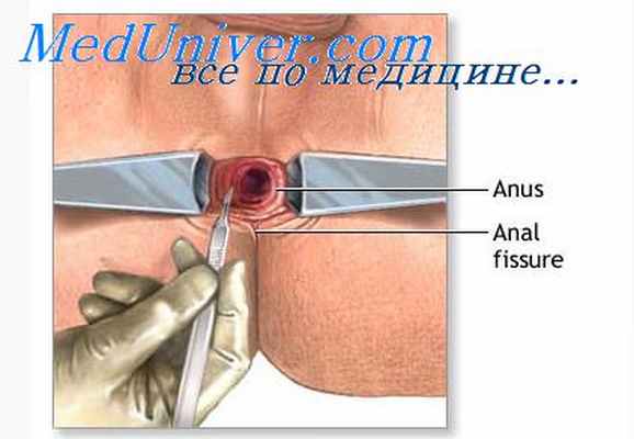 сфинктерометрия