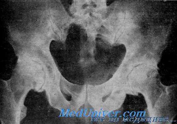 артроз тазобедренного сустава