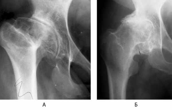 Диагностика артроза тазобедренного сустава