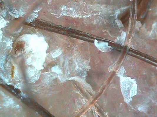 Перхоть - себорейный дерматит.jpg