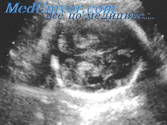 кистозная гигрома у плода