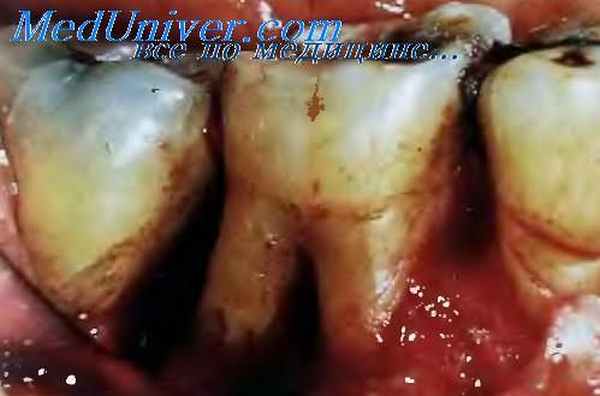 запущенный периодонтит