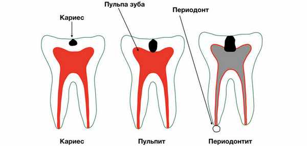 Периодонтит зуба на схеме