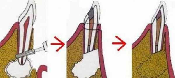 Гемисекция