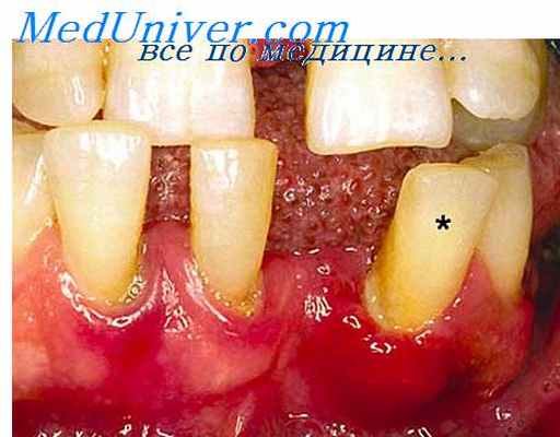 шинирование зубов