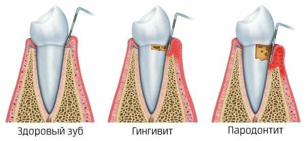 Запущенный пародонтит нередко приводит к расшатыванию и подвижности зубов