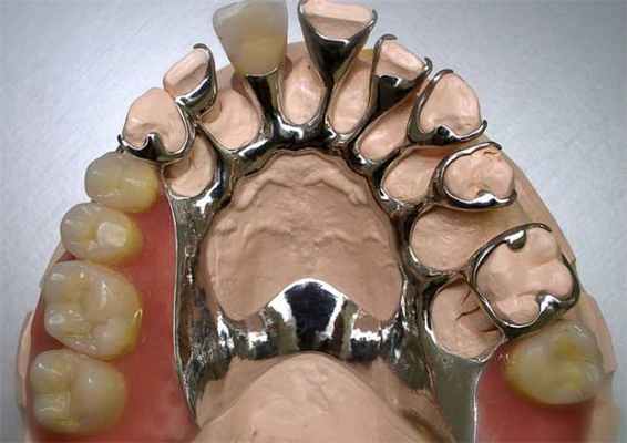 shiniruyushchij-byugelnyj-protez1