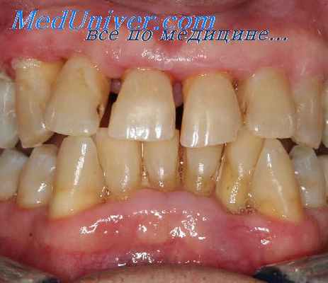 зубные бляшки