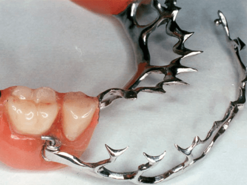 Бюгельный протез шинирующий