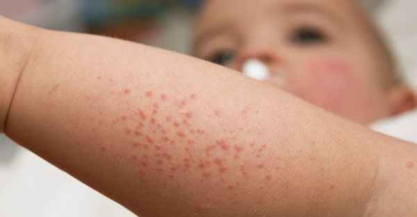 Фолликулярный гиперкератоз