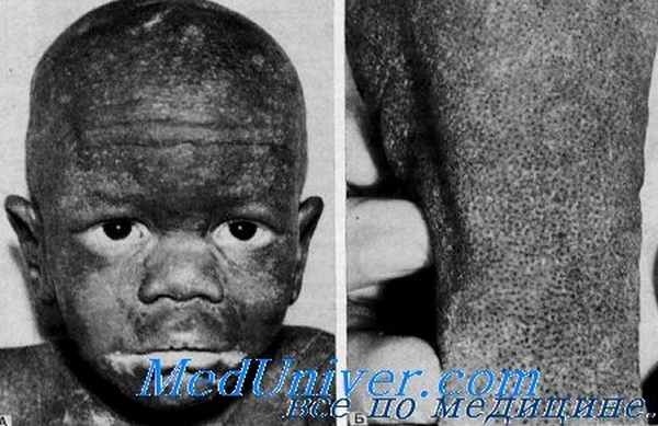 гиперкератоз с облысением