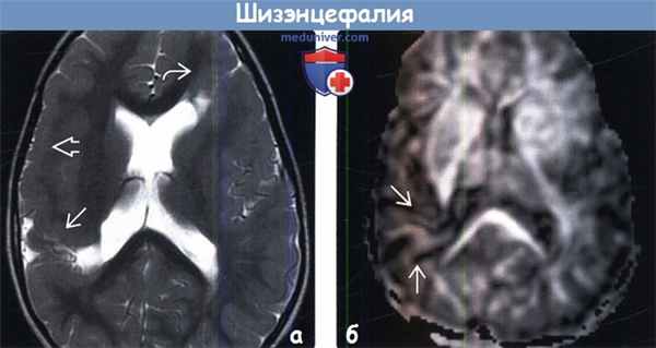 Шизэнцефалия на МРТ