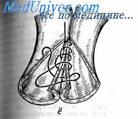 шов коннеля