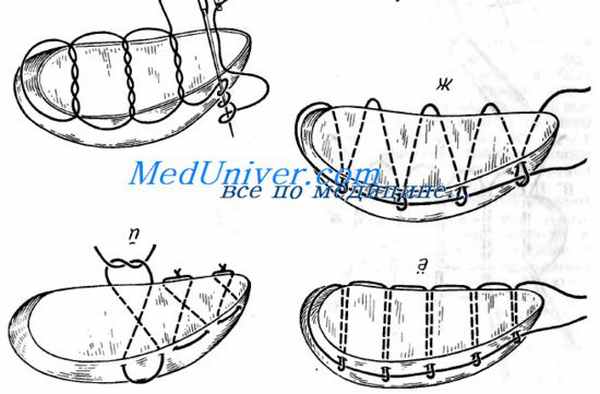 швы раны печени