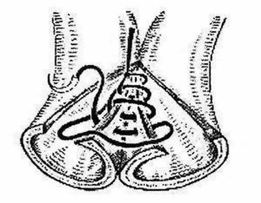 Непрерывный кишечный шов Ревердена-Мультановского