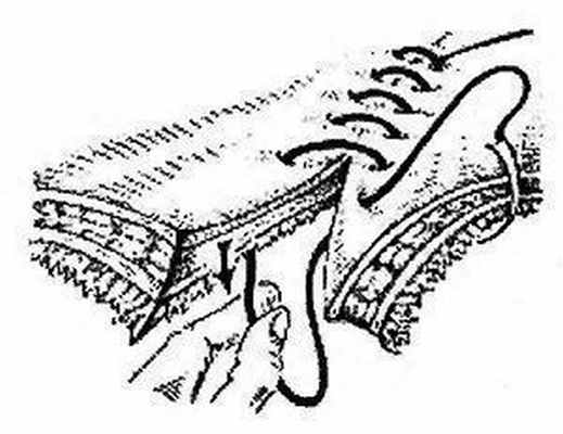 Непрерывный кишечный шов Микулича