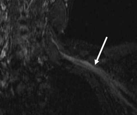 повреждение плечевого сплетения