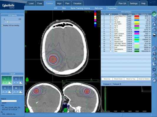 Ганглиоцитома (ганглионеврома) - план лечения на КиберНоже
