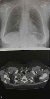 Снимки МРТ и КТ. Нейрогенные опухоли