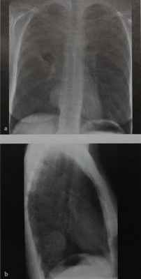 Снимки МРТ и КТ. Нейрогенные опухоли
