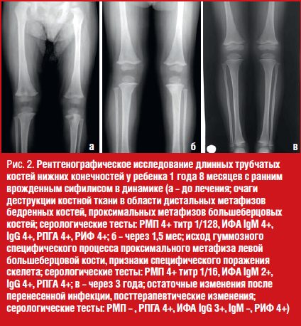 Рентгенографическое исследование длинных трубчатых костей нижних конечностей у ребенка 1 года 8 месяцев с ранним врожденным сифилисом в динамике