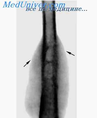 сифилис костей