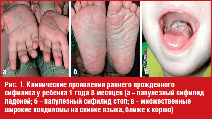 Клинические проявления раннего врожденного сифилиса у ребенка 1 года 8 месяцев