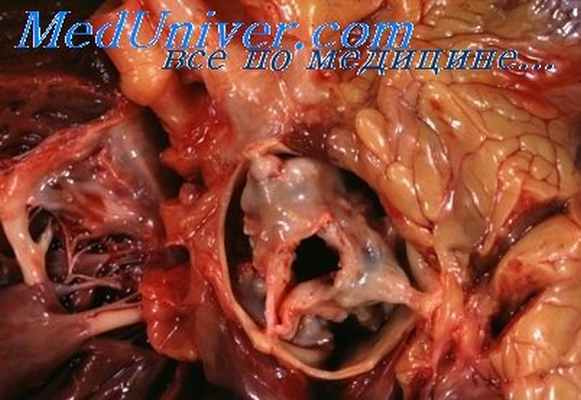 сифилис сердца