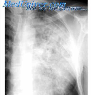 силикотуберкулез