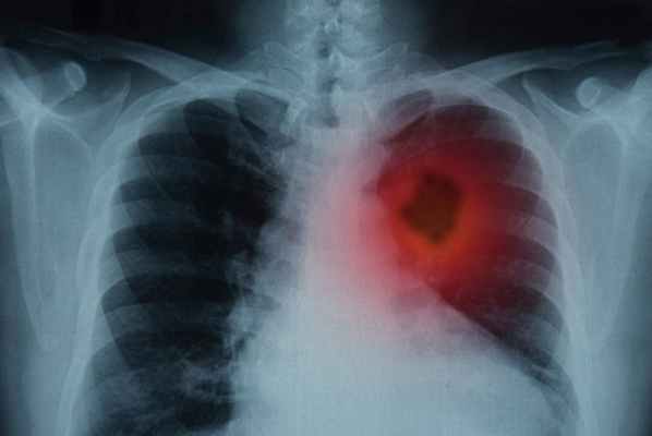 Диагностика и реабилитация центрального рака легкого