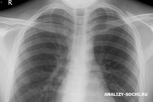 Рентген легких