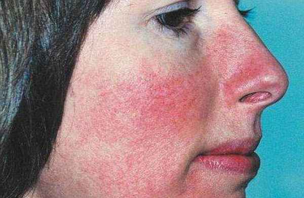 Блашинг-синдром: описание, причины, методы диагностики и особенности лечения